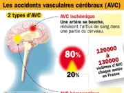 Les AVC en Afrique : « prévenir vaut mieux que guérir »